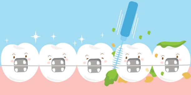 Clean Your Teeth Effectively with Braces